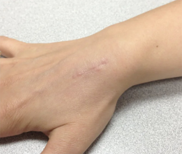 healed scar after using dermaclip